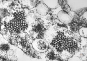 F,50y. | papilomavirus in glial cell - progressive multifocal leukodystrophy